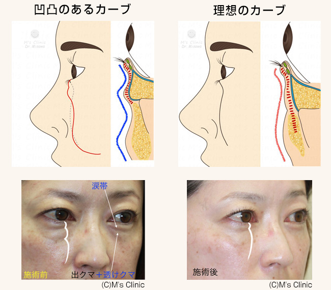 下まぶたのたるみ取り
