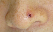 皮膚悪性腫瘍症例