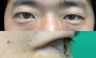 睫毛内反症(逆さまつげ:上まぶた)症例