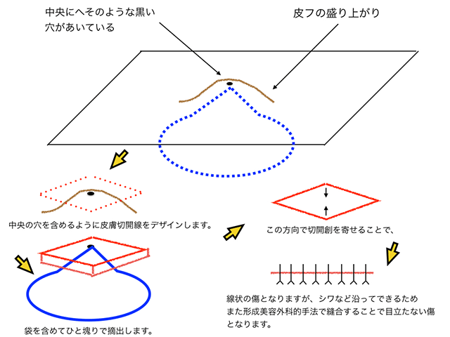 粉瘤の治療法