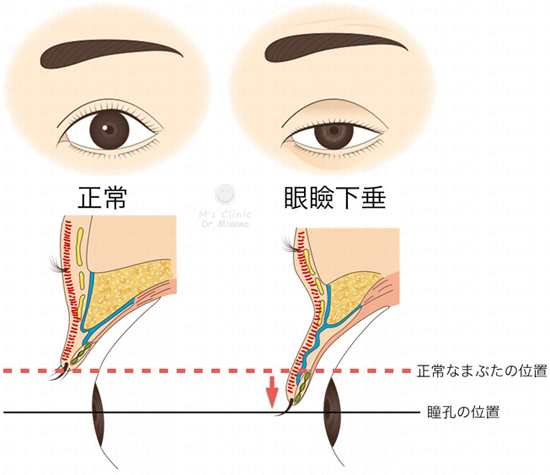眼瞼下垂とは