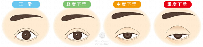 眼瞼下垂の重症度