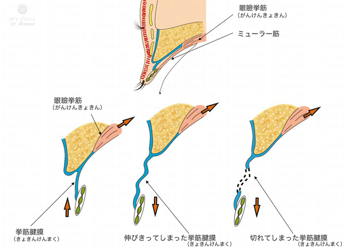 眼瞼下垂の症状は?