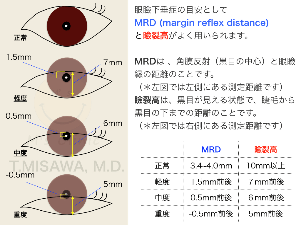 眼瞼下垂の重症度